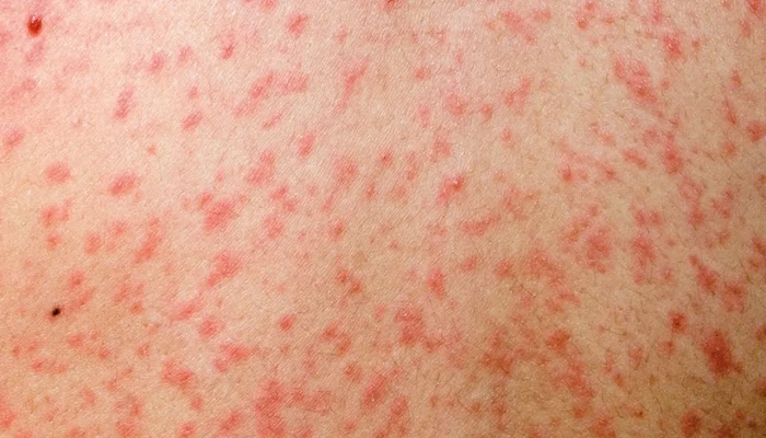 ​হামে আরও ৪ জনের প্রাণহানি, নতুন শনাক্ত ৬৮৫